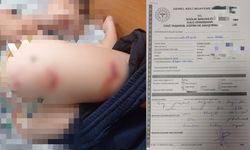 Diyarbakır’da sokak köpeği dehşeti: 9 yaşındaki çocuk defalarca ısırıldı