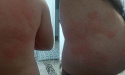 Böcek ısırığı hastanelik etti!