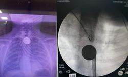 Boğazına para kaçan çocuk, az daha canından oluyordu