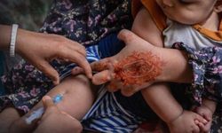Kızamık salgınında 986 çocuk yaşamını yitirdi