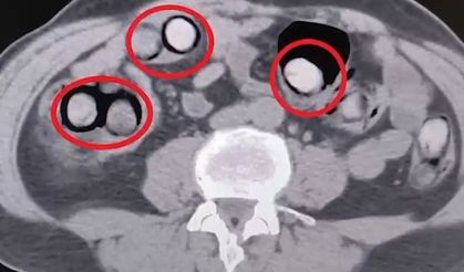 Mide ve bağırsaklarından 758 gram uyuşturucu çıktı
