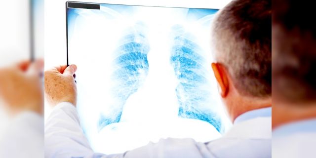 Akciğer kanserinde nodül büyüklüğüne dikkat