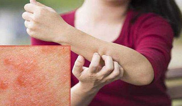 Uyuz hastalığı neden artıyor?