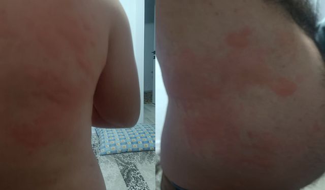 Böcek ısırığı hastanelik etti!