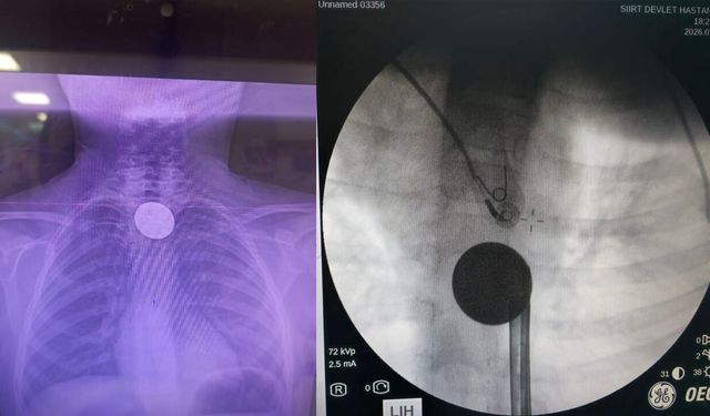 Boğazına para kaçan çocuk, az daha canından oluyordu
