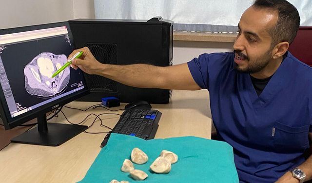 Diyarbakır’da akıllara durgunluk veren olay; İdrar kanalından yarım kilo taş çıktı