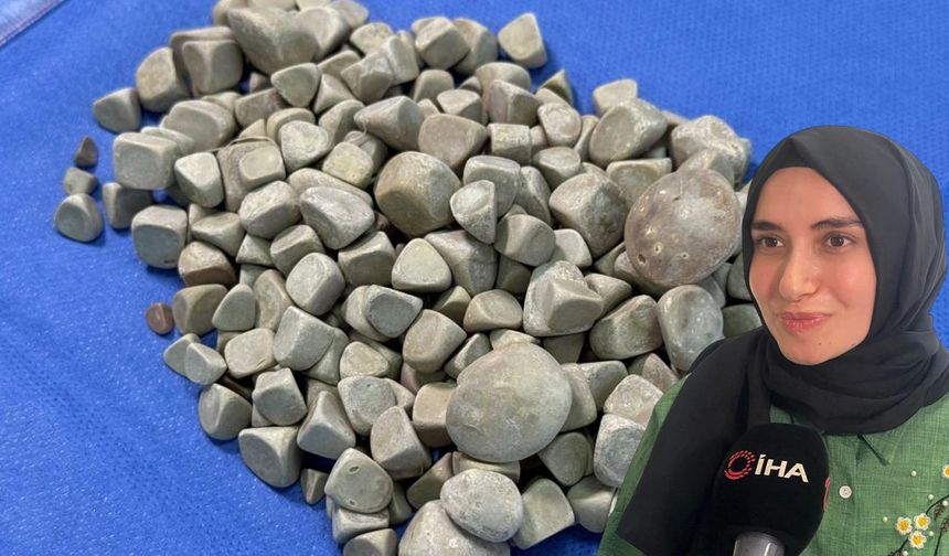 Vücudundan 287 taş çıkarıldı, doktorlar bile şok oldu