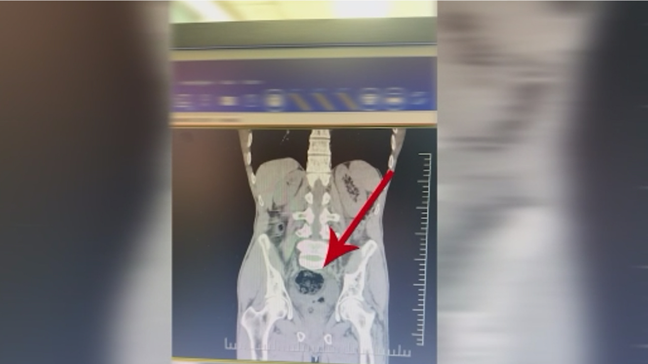 Batman'da Midesinde Uyuşturucu Çıktı1