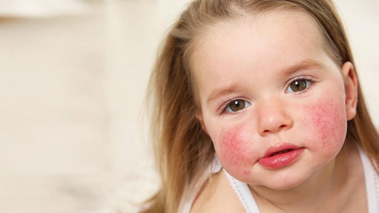 Çocuğum Alerjik Mi, Değil Mi