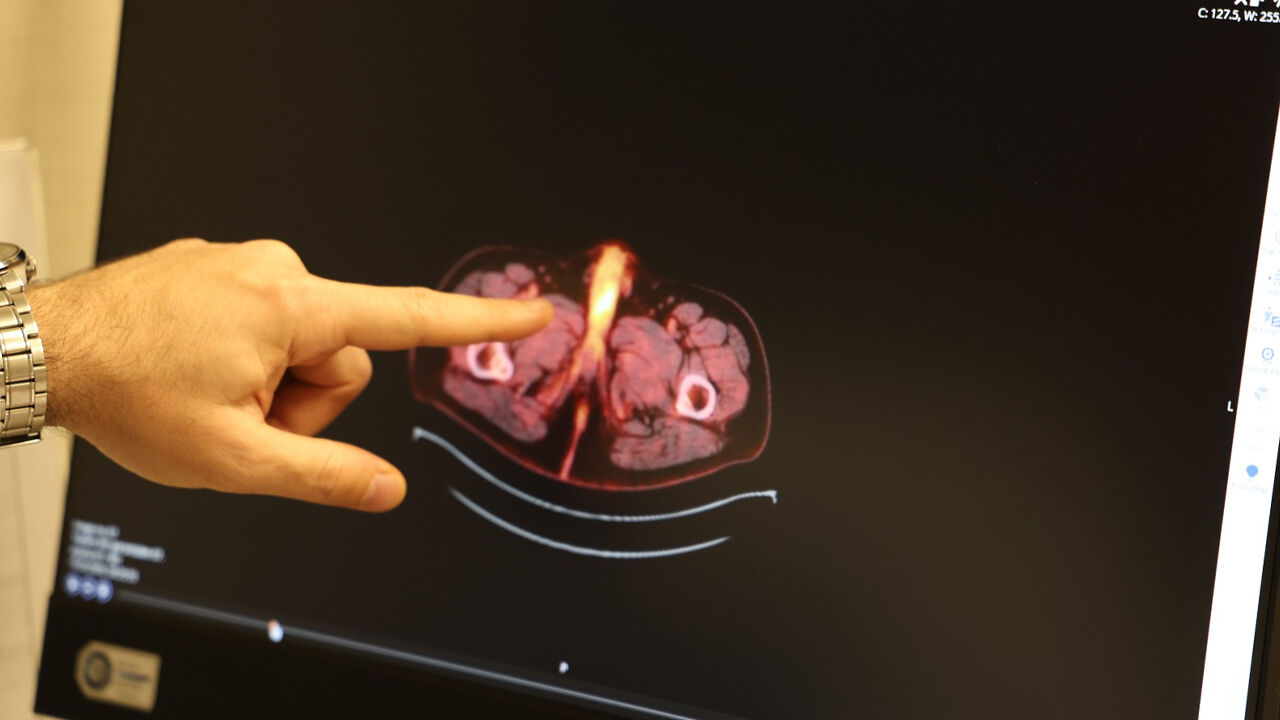 Dünyada 60 Kişide Görülmüştü2