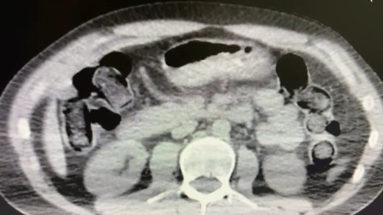 Midelerinde Uyuşturucu Sevkiyatı Yapan 2 Kişi Tutuklandı